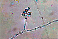 esporotricosis3