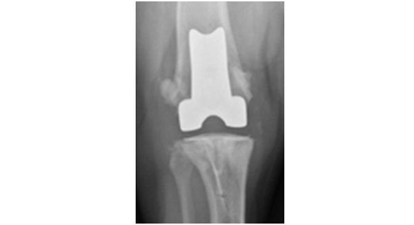 rodilla-2