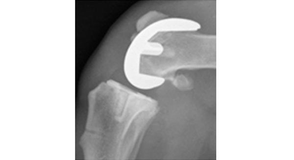 rodilla-3