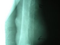Osteosarcoma y Citología: Un Hueso No Tan Duro De Roer..!!