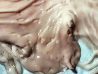 Interacciones de los corticosteroides y los antiinflamatorios no esteroideos