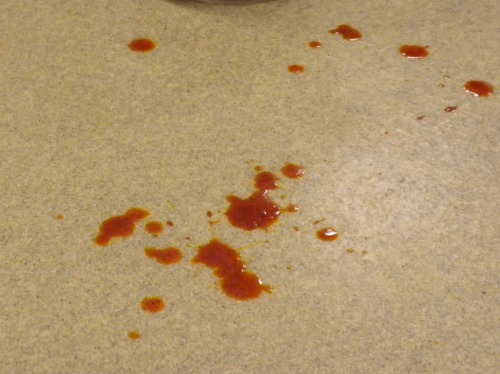 Hemorrhagic diarrhea2