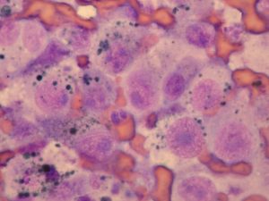 Citología de melanoma poco diferenciado donde no hay mucha presencia de granulos de melanina