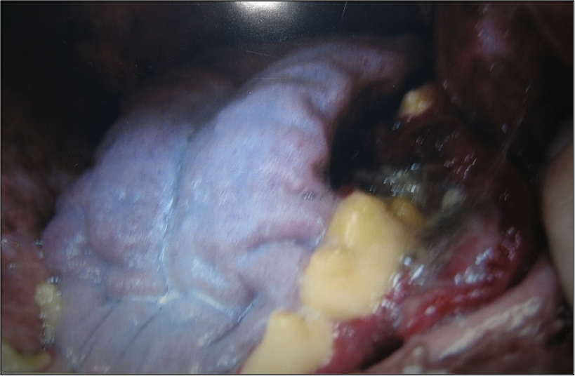Respuesta en un caso donde se utilizó la vacuna de melanoma ONCEPT de Merial junto con radioterapia fraccionada