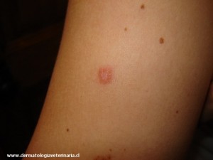Lesión de tiña en el brazo de una persona.
