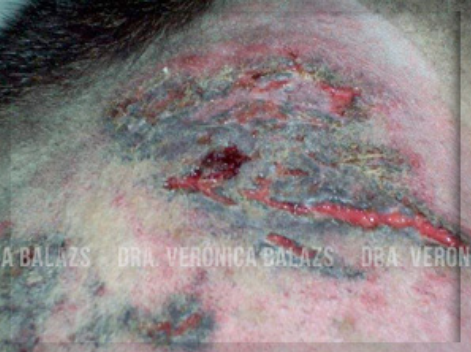 Vista ampliada de las lesiones de la foto anterior: región lateral del muslo con tejido desvitalizado, costras, úlceras y tractos drenantes.