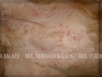 Foliculitis superficial, fácil de diagnosticar, por la presencia de lesiones primarias: pústulas y pápulas