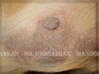 Pioderma en el Canino Part. II: Piodermas Superficiales