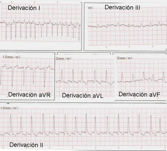 ECG RETO