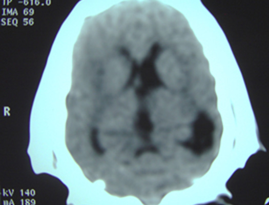 Hidrocefalia asimétrica y mayor captación de contraste en corteza.