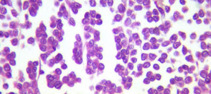 HISTOPATOLOGÍA DE EFUSIONES: Es posible…!
